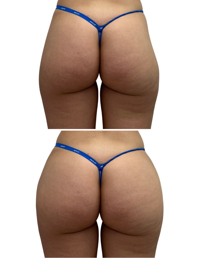 AlloClae buttocks before and after at BeautyFix